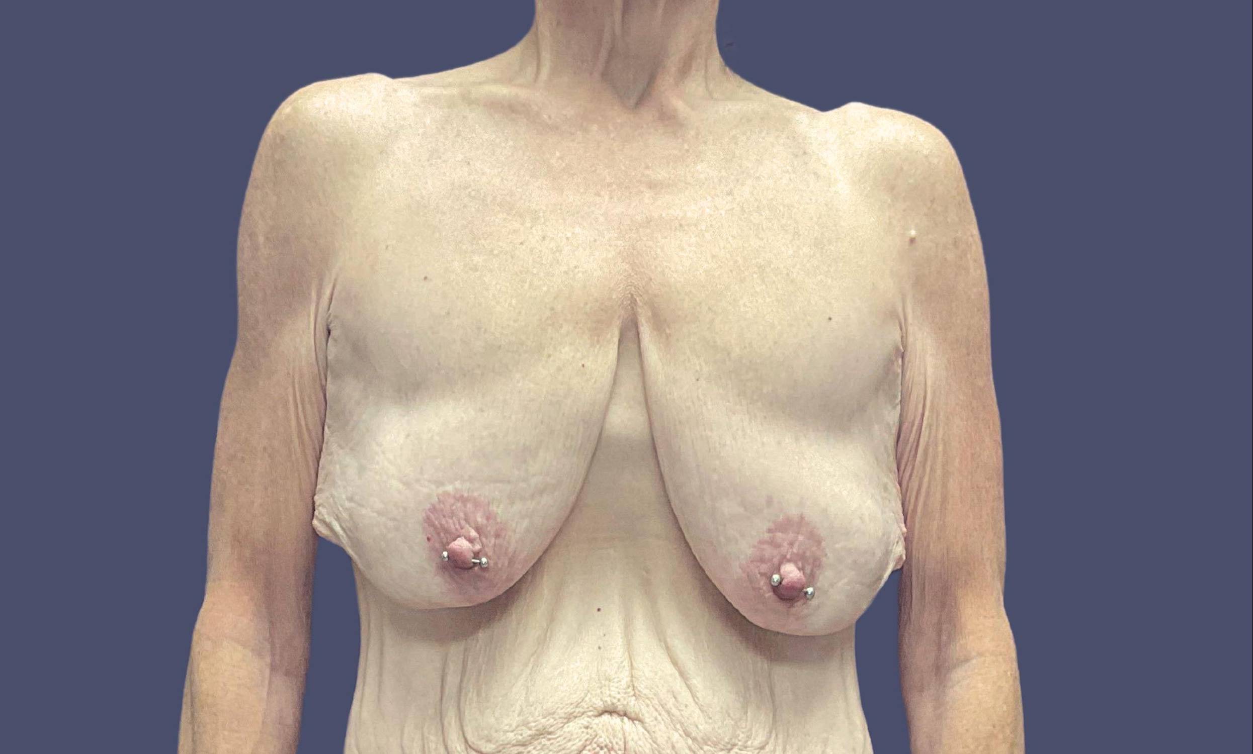 Breast Lift w/Fat Transfer 2 Before