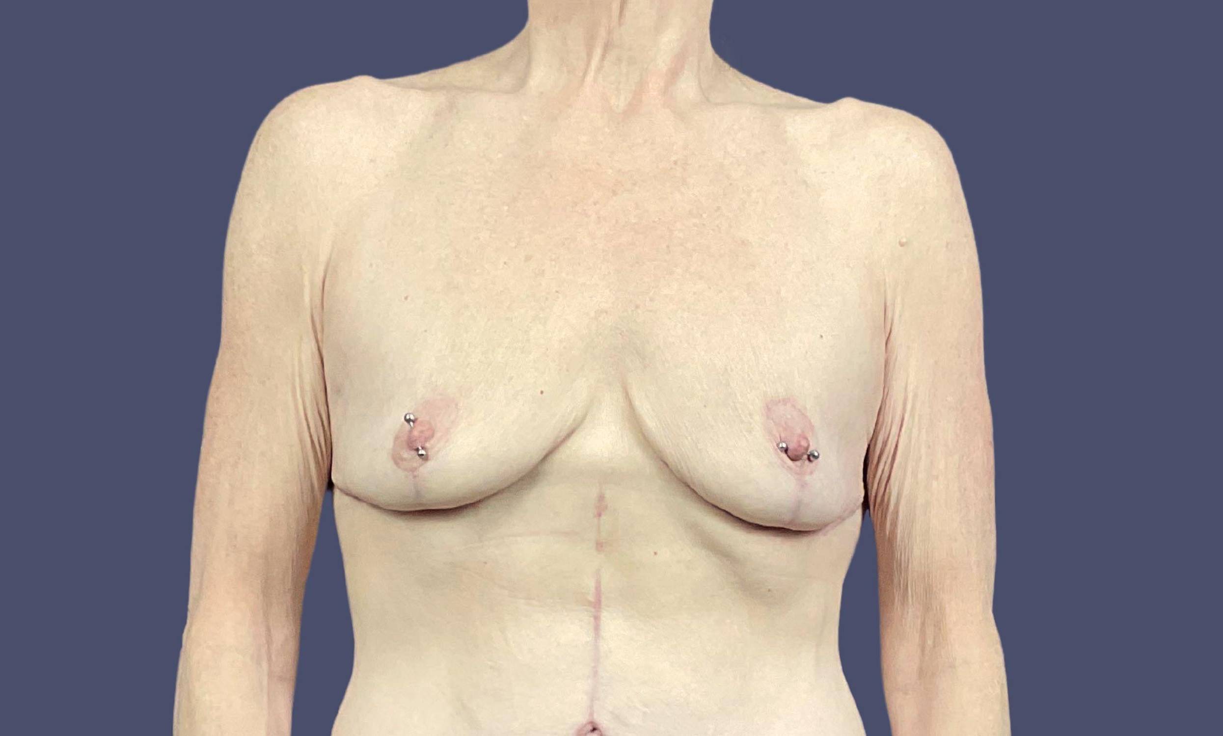 Breast Lift w/Fat Transfer 2 After