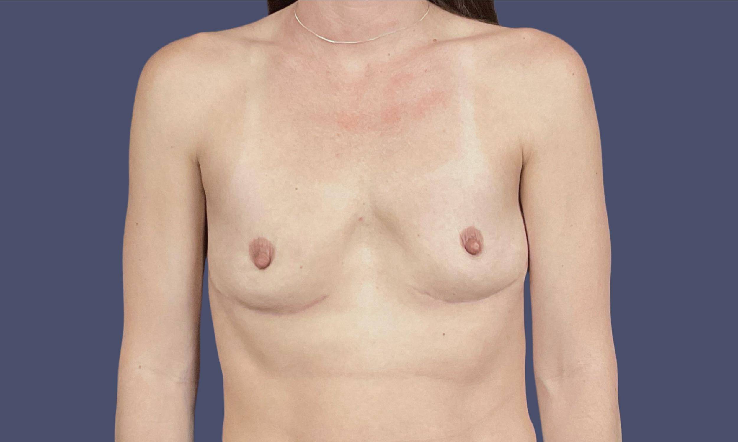 Breast Implant Removal 4 After