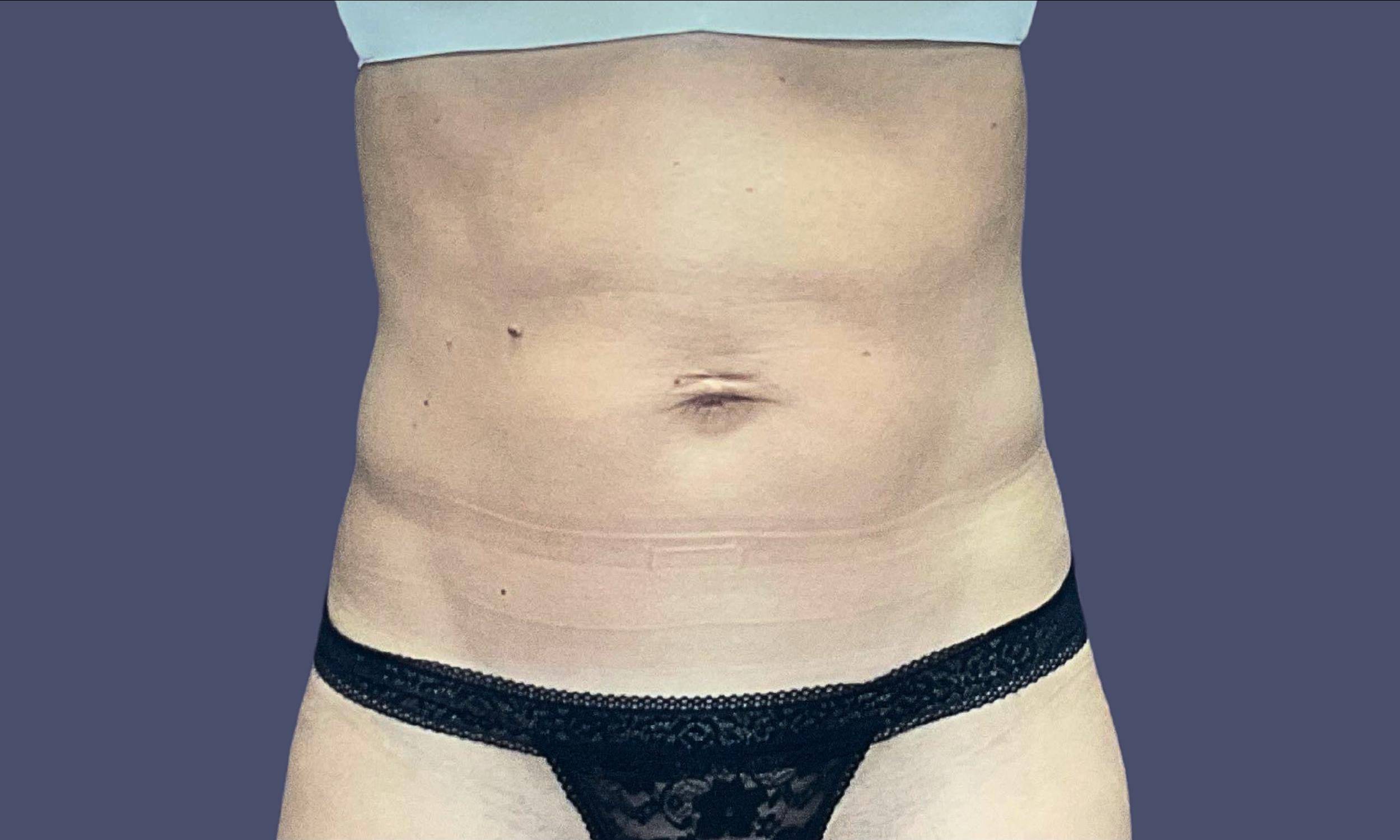 Abdominoplasty (Tummy Tuck) 31 Before