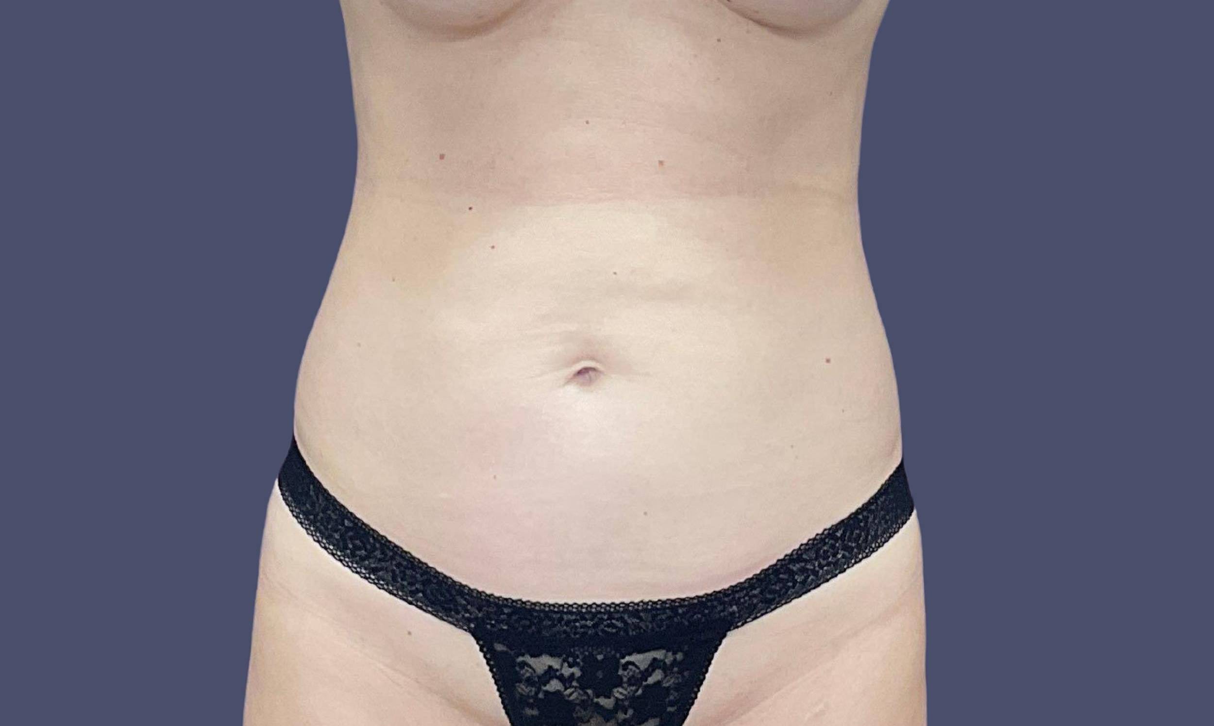Abdominoplasty (Tummy Tuck) 32 Before