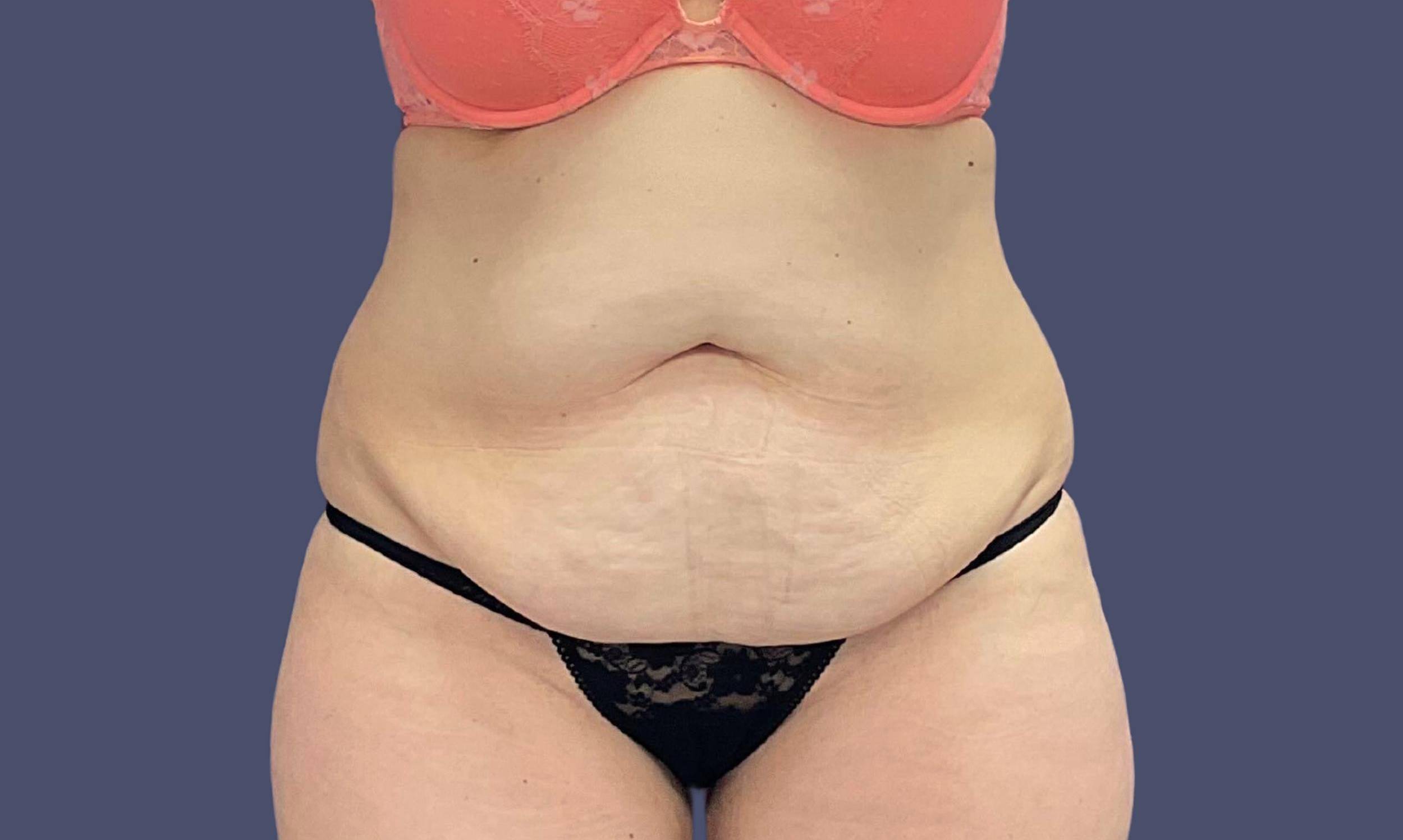 Abdominoplasty (Tummy Tuck) 8 Before