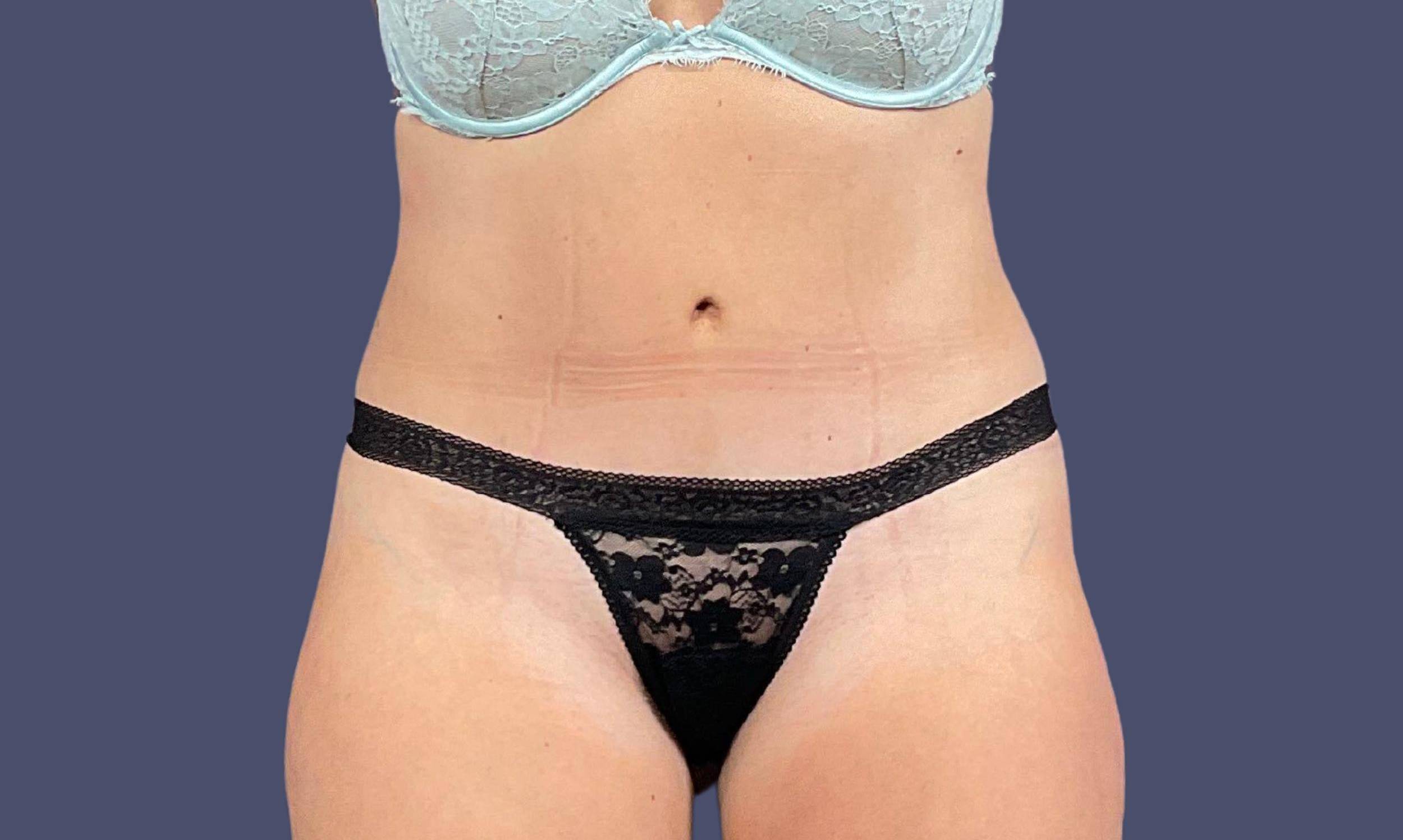Abdominoplasty (Tummy Tuck) 8 After