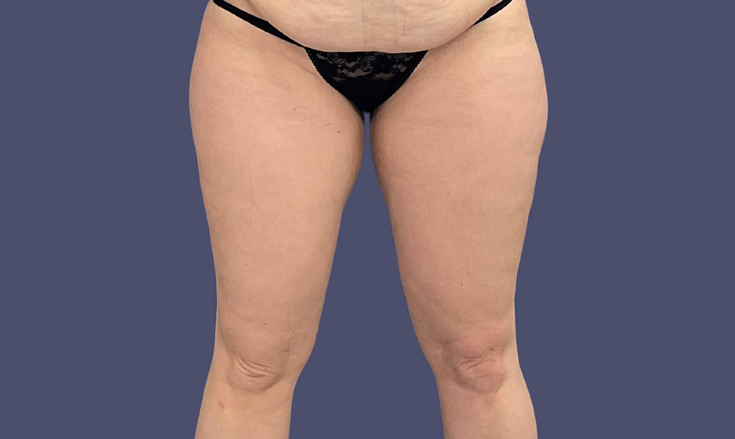 Liposuction 10 - Lateral Thighs Before