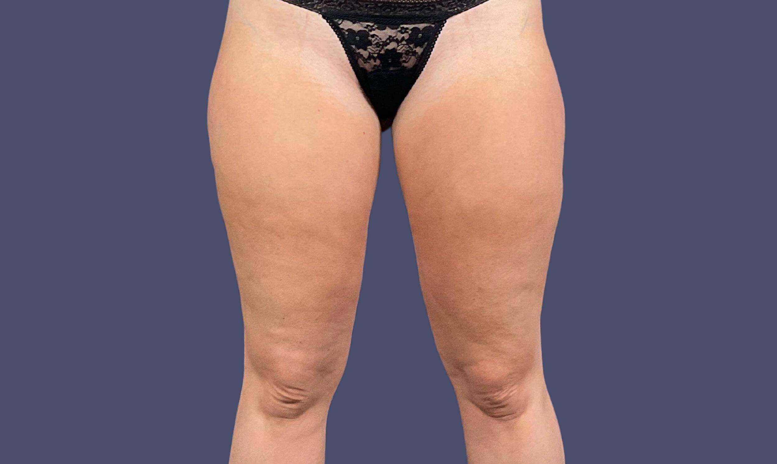 Liposuction 10 - Lateral Thighs After