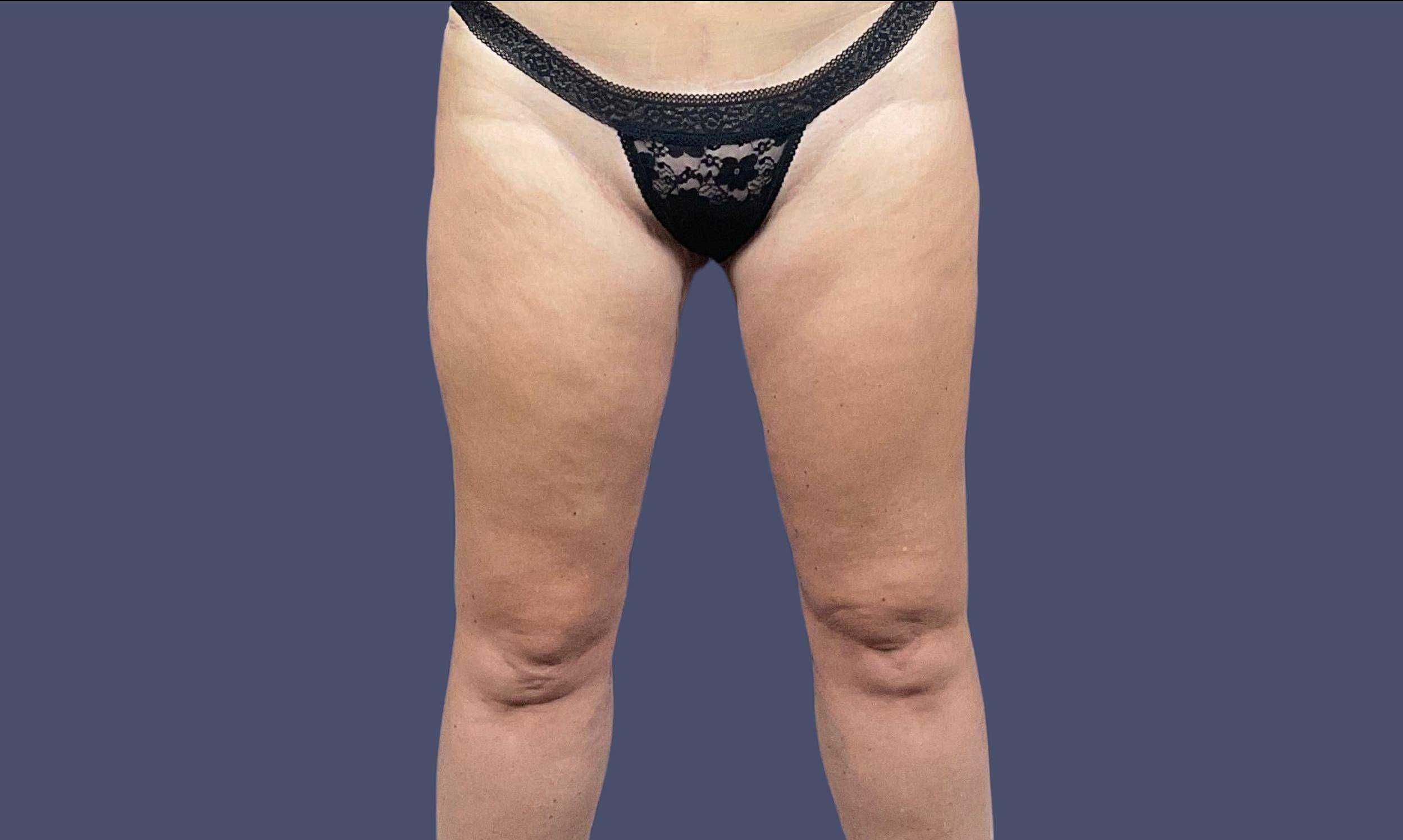 Thigh Lift 5 After