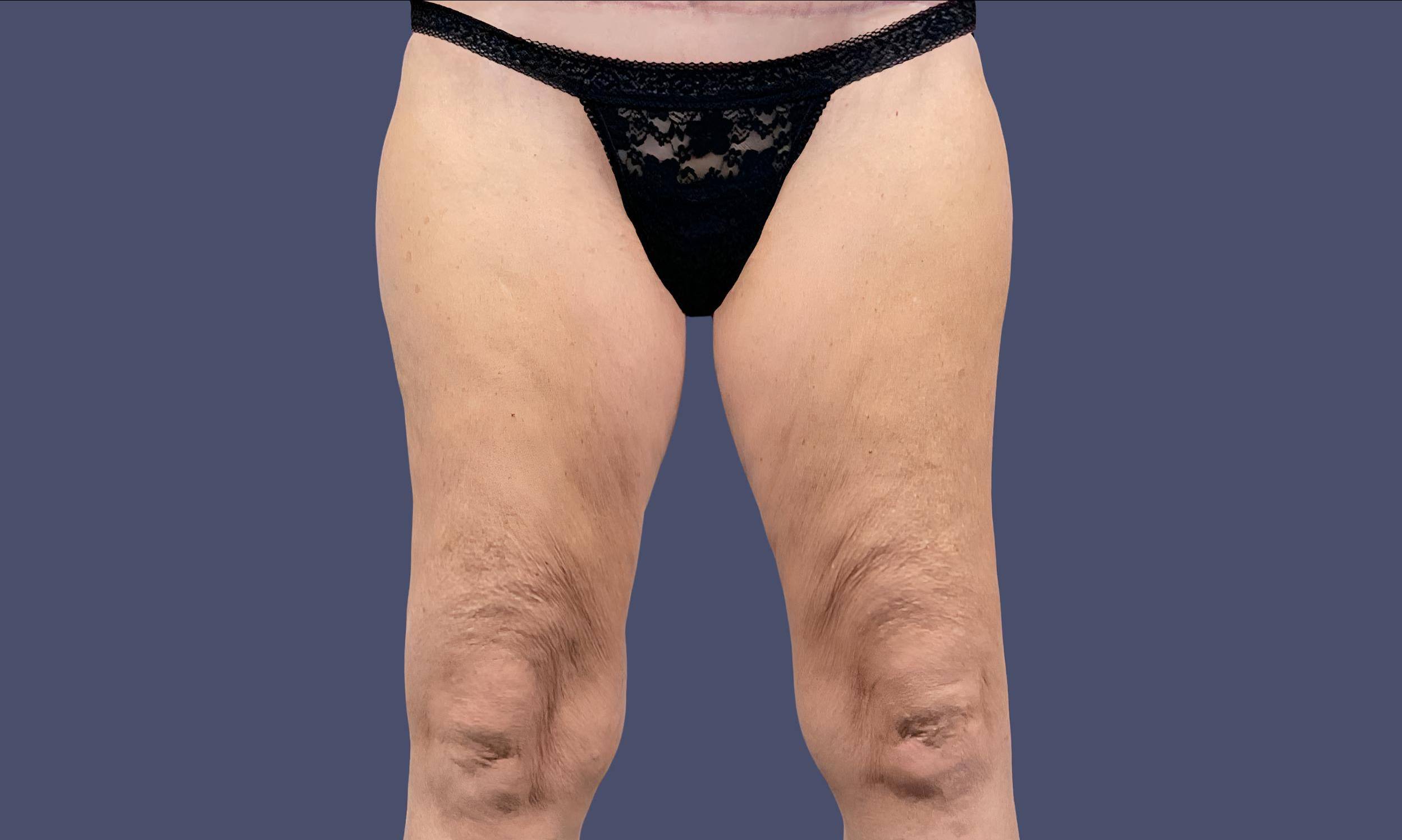 Thigh Lift 6 Before