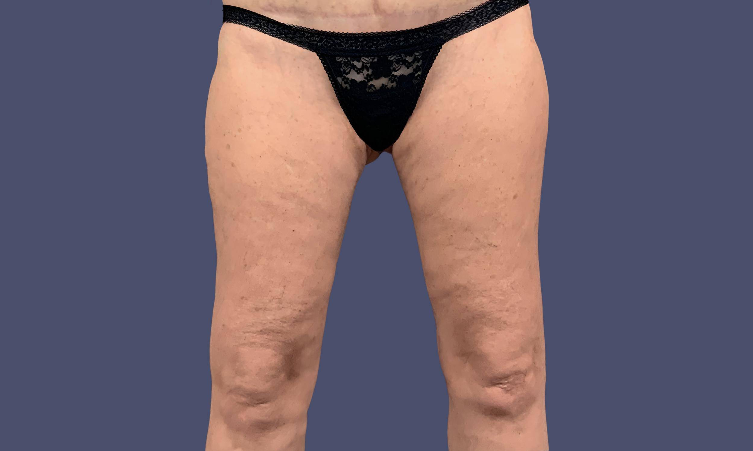 Thigh Lift 6 After