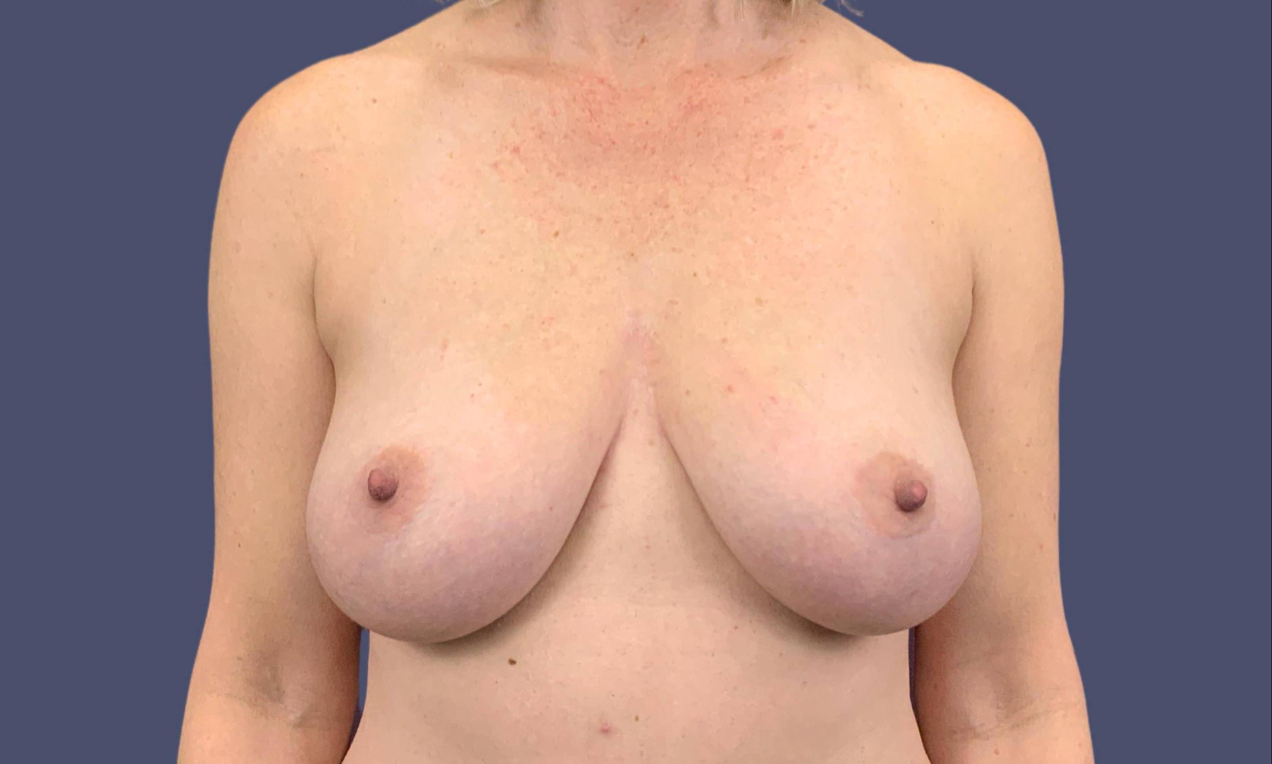 Breast Reduction with Augmentation 1 Before