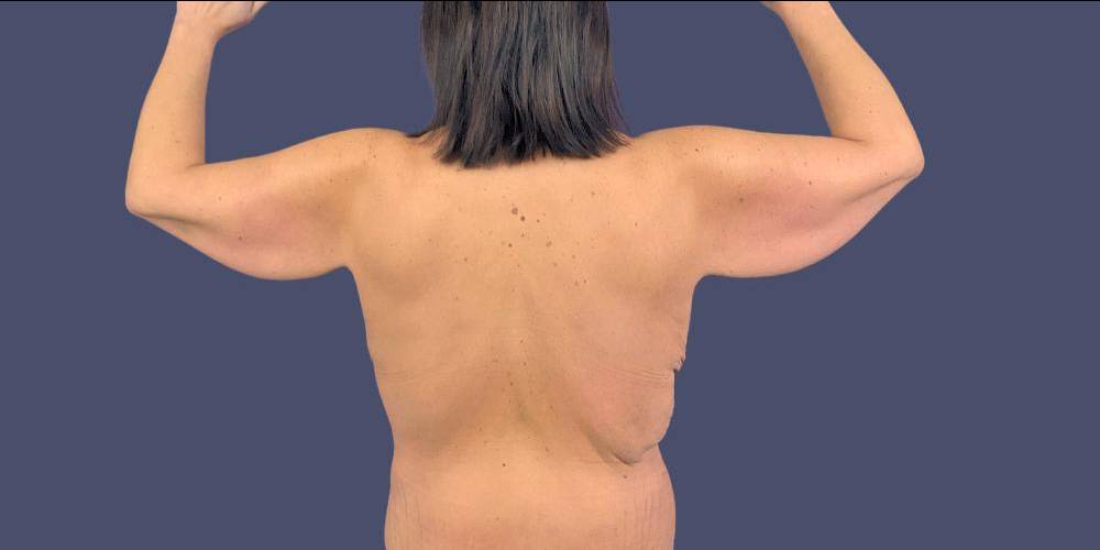 Brachioplasty (Arm Lift) 1 Before