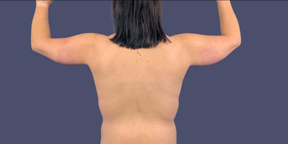 Brachioplasty (Arm Lift) 1 After