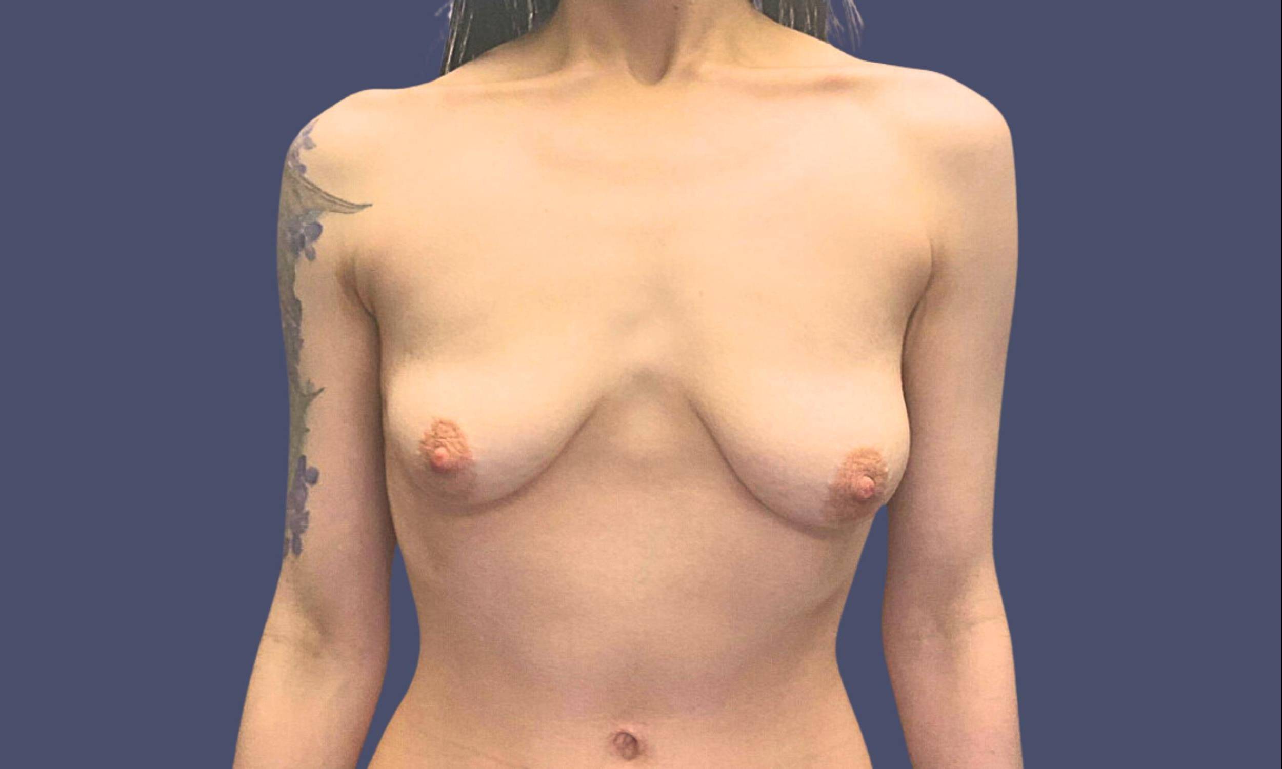 Breast Lift 5 Before