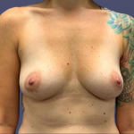 Breast Augmentation 2 Before