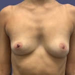 Breast Augmentation 9 Before