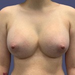 Breast Augmentation 4 After