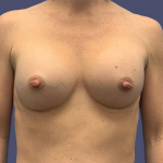 Breast Augmentation 12 After