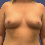 Breast Augmentation 20 Before