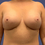 Breast Augmentation 20 After