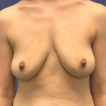 Breast Augmentation 34 Before