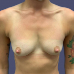 Breast Augmentation 1 Before