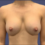 Breast Augmentation 14 After