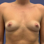 Breast Augmentation 12 Before