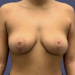 Breast Lift 1 After