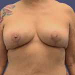 Breast Lift 4 After
