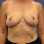 Breast Lift 2 After