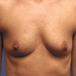Breast Augmentation 32 Before