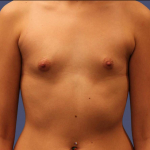 Breast Augmentation 21 Before