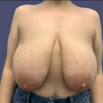 Breast Reduction 1 Before