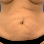 Abdominoplasty (Tummy Tuck) 8 Before