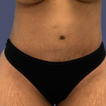 Abdominoplasty (Tummy Tuck) 22 After