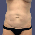 Abdominoplasty (Tummy Tuck) 7 Before