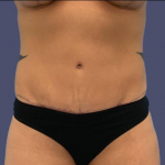 Abdominoplasty (Tummy Tuck) 19 After