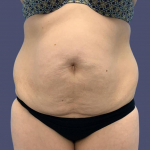 Abdominoplasty (Tummy Tuck) 5 Before