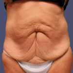 Abdominoplasty (Tummy Tuck) 19 Before