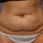 Abdominoplasty (Tummy Tuck) 16 Before