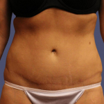 Abdominoplasty (Tummy Tuck) 13 After