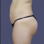 Liposuction 3 - Abdomen, Flanks, & Back Before