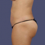 Liposuction 3 - Abdomen, Flanks, & Back After