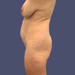 Liposuction 1 - Axilla, Abdomen, and Anterior Flanks Before