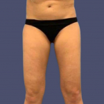 Liposuction 7 - Thighs Before