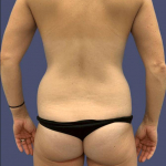 Liposuction 6 - Posterior Flanks Before