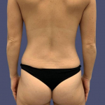 Liposuction 6 - Posterior Flanks After