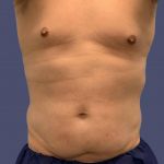 Liposuction 4 - Abdomen and Posterior Flanks Before