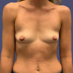 Breast Augmentation 25 Before