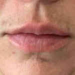 Lip Filler 16 After