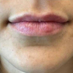 Lip Filler 9 After